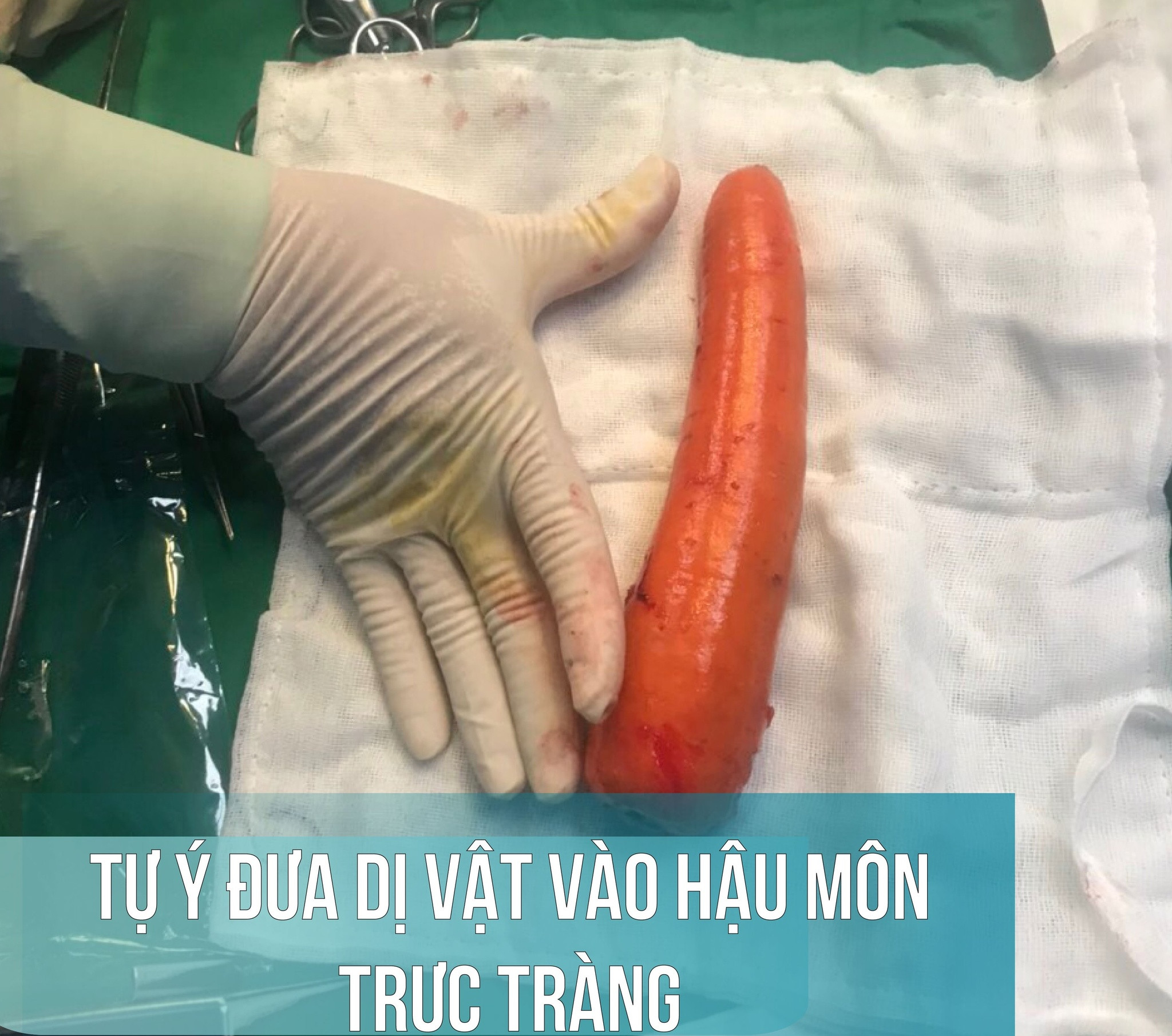 Thanh niên bị mắc kẹt củ cà rốt dài 20 cm trong hậu môn