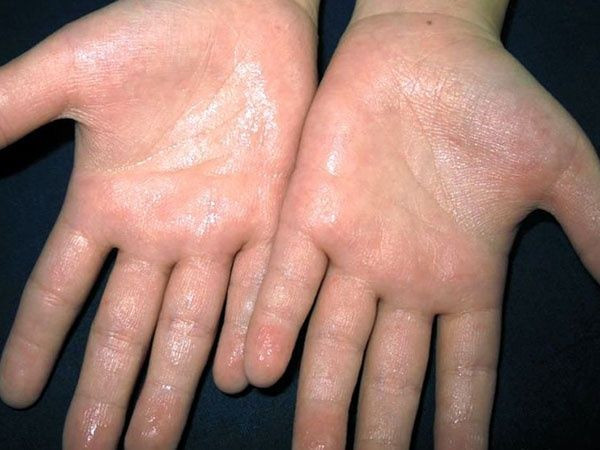 Bệnh ra mồ hôi nhiều
