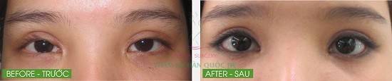  Trong trường hợp không may bị cắt mí hỏng, khiến mí to, giả và hai vết sẹo xấu lộ rõ, có thể nhờ đến kỹ thuật phẫu thuật hiện đại chữa trị cho mắt trở nên to tròn tự nhiên hơn.