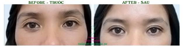 Nếu hốc mắt sâu do can thiệp lấy mỡ quá mức, có thể cấy mỡ và tái tạo lại mí để mắt trở nên trẻ trung và sinh động hơn.