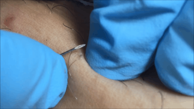 Sốc trước hiện tượng 'lông mọc ngược' dưới da Ảnh 2