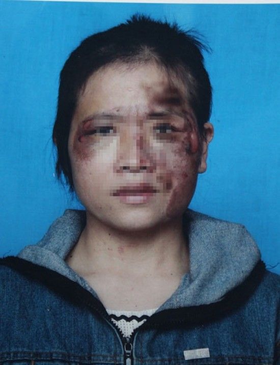 Khuôn mặt biến dạng của chị H.