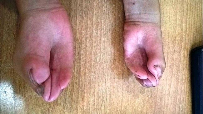 Đôi bàn tay cũng dị dạng do các ngón tay dính liền với nhau. 