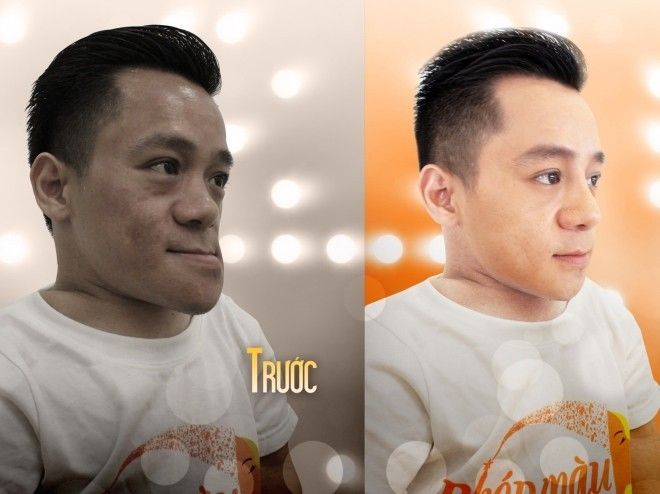 Sơn Lâm: Trước và sau khi phẫu thuật chỉnh hình mặt