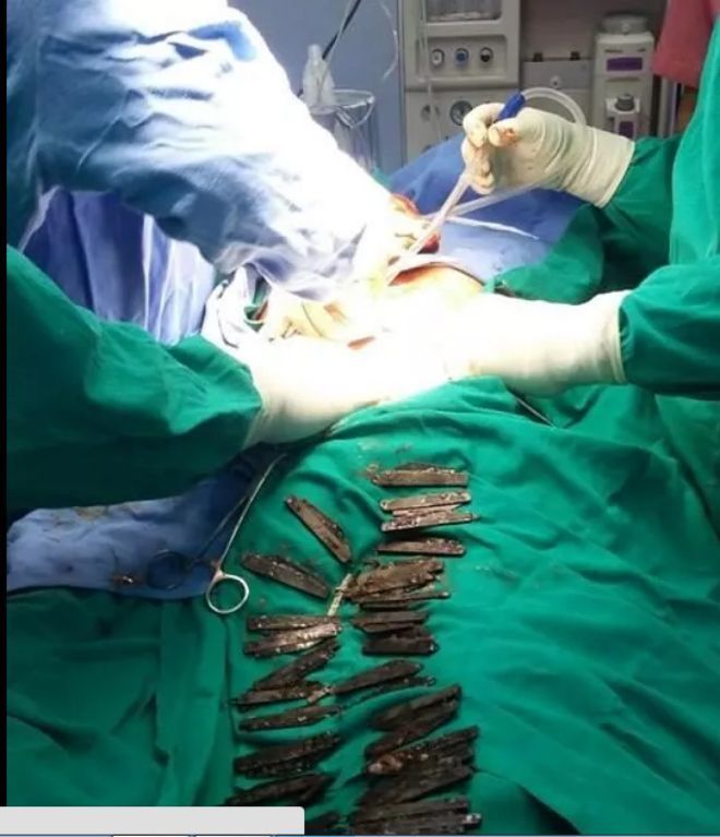 Các bác sĩ tiến hành lôi 40 con dao ra khỏi bụng bệnh nhân.