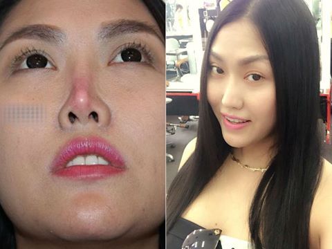 Cô đã từng dành một khoảng thời gian dài đến… 11 năm chỉ cho việc chỉnh sửa chiếc mũi của mình! Thậm chí có thời gian, chiếc mũi của Phi Thanh Vân đã có dấu hiệu hoại tử. 