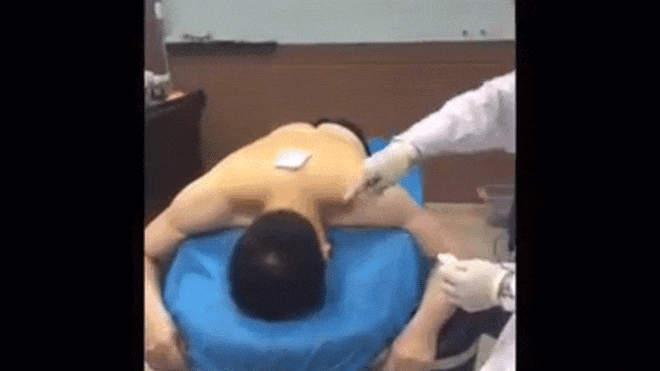 Màn châm cứu bằng 'kim tiêm voi' khiến bất cứ ai cũng phải toát mồ hôi Ảnh 2