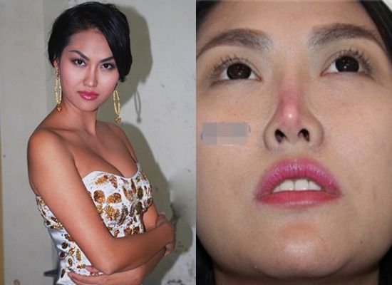 Phẫu thuật quá nhiều lần, chiếc mũi của "người đẹp dao kéo" Phi Thanh Vân có dấu hiệu hoại tử. 
