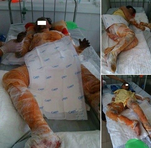 3 người trong gia đình Hằng bị bỏng nặng, đều nhập viện. Ảnh chụp màn hình.