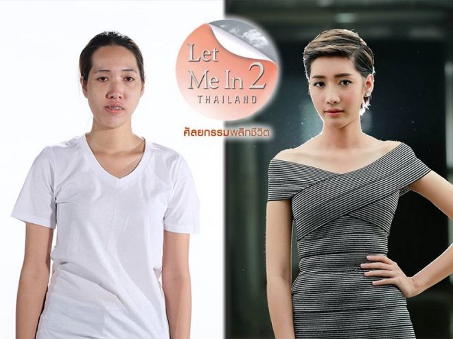 Sau khi phẫu thuật cố định hàm và tiếp tục cải thiện ngoại hình, Namthip đã đạt được sự tự tin hơn và thậm chí đã bắt đầu tham gia một khóa học người mẫu để theo đuổi ước mơ lớn nhất.