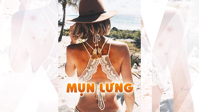 Hè là mùa lên rừng xuống biển, cớ sao mình lại ủ rũ vì 'kẻ thù' mụn lưng? Ảnh 2