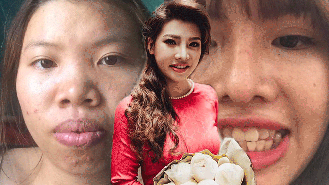 Đã chi 200 triệu trùng tu nhan sắc, giờ đây Quách Phượng lại tiếp tục bỏ 60 triệu làm lại răng Ảnh 2