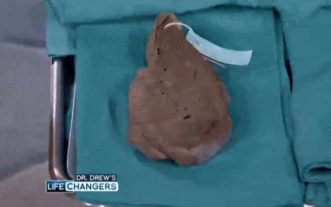 Sự khác biệt gây sốc giữa gan người nghiện rượu lâu năm và người khỏe mạnh Ảnh 2