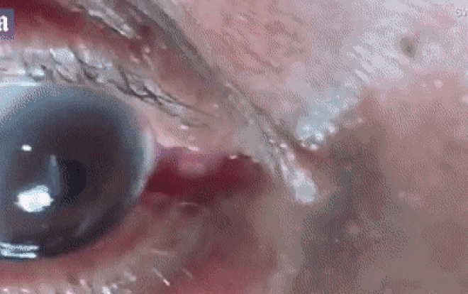 Giun dài 15 cm ngoe nguẩy trong mắt bệnh nhân khiến bác sĩ cũng phải khiếp đảm Ảnh 2