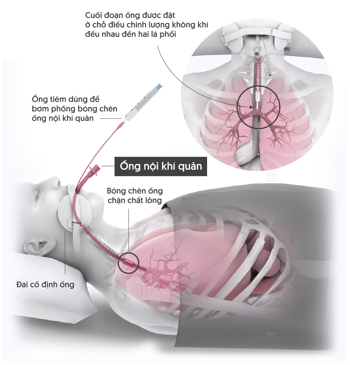 Máy thở hoạt động như thế nào với vai trò sống còn trong cuộc chiến chống COVID-19? Ảnh 12