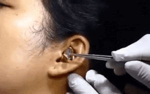 Clip: Kinh hoàng người phụ nữ bị một con rắn 'làm ổ' trong tai