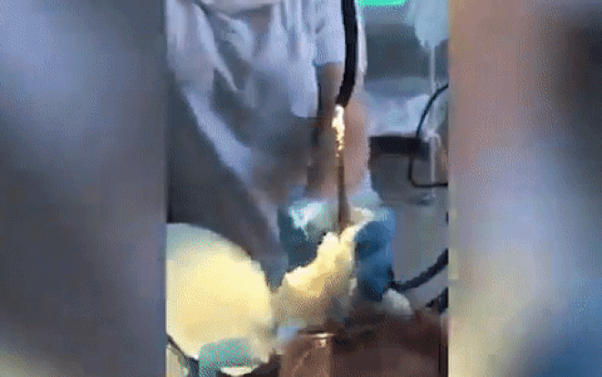 Hãi hùng cảnh lôi con rắn 1,2 m ra khỏi cổ họng người phụ nữ ở Nga Ảnh 2