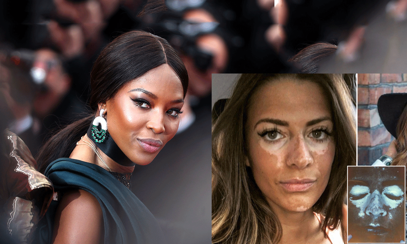 Top 10 người mẫu có khuyết điểm xấu xí nhưng vẫn siêu hot khắp thế giới Ảnh 2