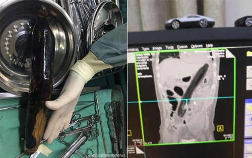 Người đàn ông nhét cà tím 30 cm vào hậu môn để… trị táo bón