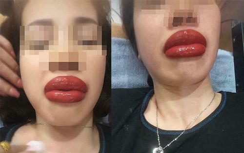 Đôi môi như muốn nổ tung của cô gái xăm môi mọng mà nhận về cái kết đắng