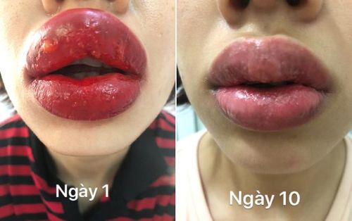 Cô gái rớt nước mắt vì môi bị sưng tều, nổi mụn nước sau khi xăm môi ở spa gần nhà