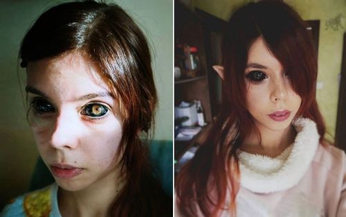 Xăm nhãn cầu để giống thần tượng, cô gái trẻ nhận cái kết đớn đau