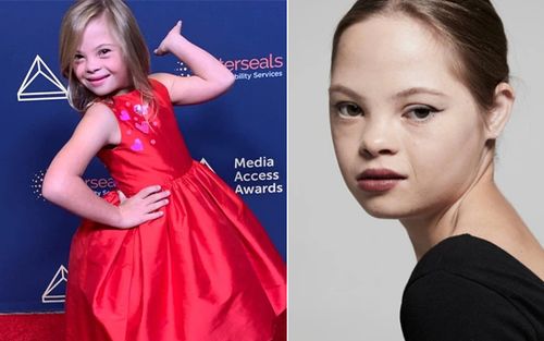 Bé gái mắc hội chứng Down bị bỏ rơi và hành trình trở thành ngôi sao Hollywood