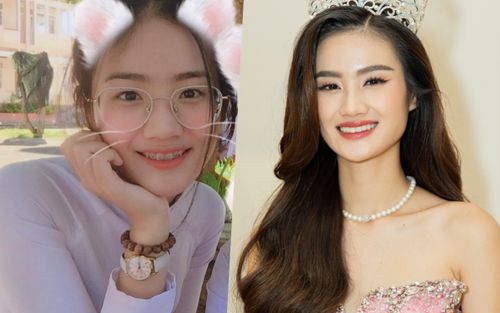 Hoa hậu Ý Nhi thăng hạng nhan sắc nhờ niềng răng