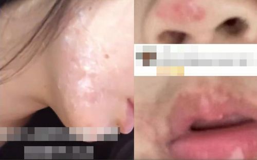 Người phụ nữ nhiễm bệnh nặng vì đi hát karaoke, không thể chữa khỏi