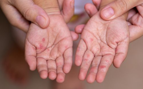Hà Nội có 203 ca mắc tay chân miệng, có ổ dịch ở trường học