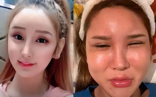 Cô gái tiêm 400 mũi filler, tốn hàng tỷ đồng để 'biến dạng'