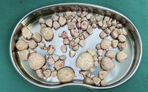 Bác sĩ cảnh báo sau ca mổ lấy 100 viên sỏi, hãy làm ngay việc này vào buổi sáng