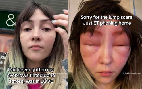 Nữ Tiktoker tá hỏa khi gương mặt biến dạng sau một lần nhuộm lông mày