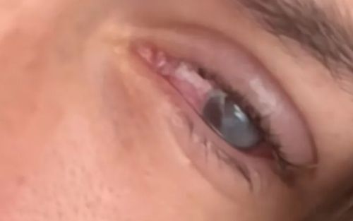 Đeo kính áp tròng, cô gái 21 tuổi gặp tình trạng có thể dẫn đến mù lòa