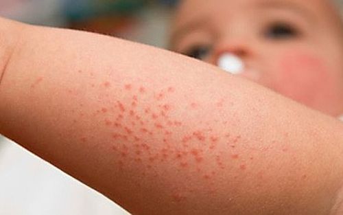 Sốt xuất huyết có thể trở nặng khi hết sốt: Những dấu hiệu cần đi viện