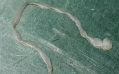 Người phụ nữ nhập viện vì bị ớn lạnh, bác sĩ kinh hoàng khi lấy ra thứ trong đầu