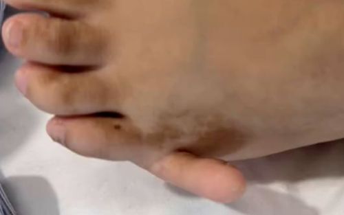 Cô gái có 6 ngón ở cả hai bàn chân, ngoại hình tuổi 17 khiến ai cũng xôn xao