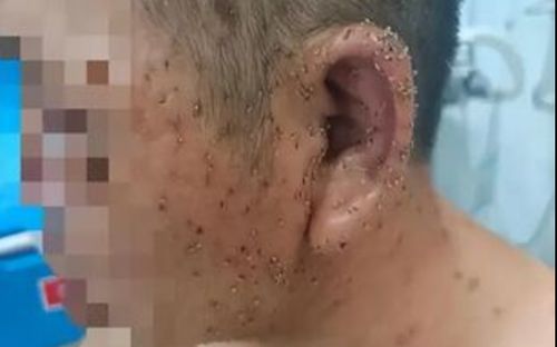 Người đàn ông bị đàn ong tấn công, bác sĩ mất 3 tiếng mới lấy hết 1.000 ngòi độc