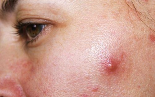 Nổi mụn ở từng vị trí trên mặt nói lên điều gì?