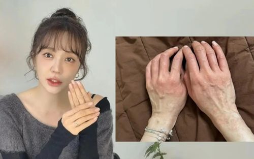 Yoon Eun Hye bị dị ứng nghiêm trọng, hai tay sưng đỏ rồi lan khắp mặt