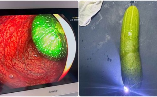 Nam sinh lớp 9 nhập viện vì 'nghịch dại', đưa quả dưa chuột dài 20cm vào hậu môn