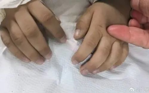 Bé trai 3 tuổi tím tái toàn thân, bác sĩ tìm ra nguyên nhân khiến nhiều phụ huynh giật mình