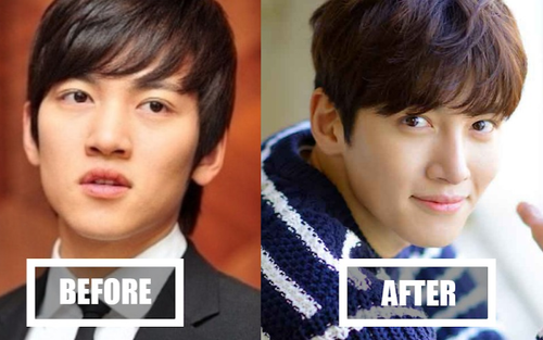 Netizen Hàn bối rối khi so sánh ảnh trước và sau phẫu thuật mũi của Ji Chang Wook