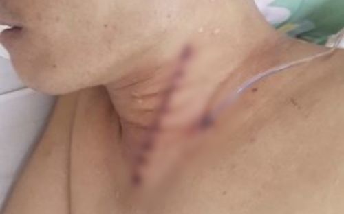 Một bệnh nhân bị hóc xương gà nguy hiểm tính mạng được cấp cứu kịp thời