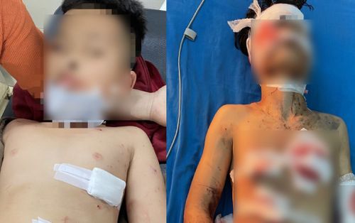 Sau tiếng nổ lớn nghi do pháo tự chế phát nổ, 4 học sinh bị thương nặng