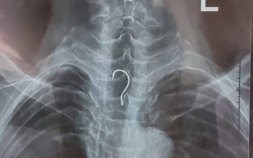 Hy hữu, nam bệnh nhân bị mắc lưỡi câu trong thực quản nhập viện khẩn