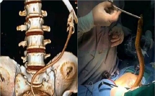 Nhét lươn vào hậu môn chữa táo bón, người đàn ông rước họa vào thân