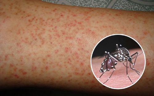 Bệnh sốt xuất huyết và những điều cần lưu ý để bảo vệ sức khỏe bản thân và gia đình