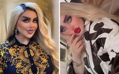 Phẫu thuật 43 lần vì muốn giống búp bê Barbie, cô gái nhận về cái kết đắng