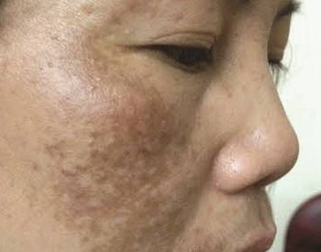 Cách hay điều trị nám da